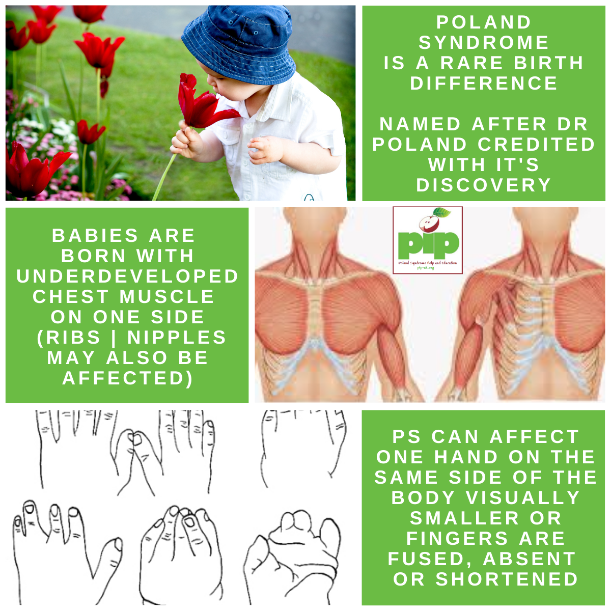 Lil Bone Peep on X: Poland syndrome: disorder w/ unilat missing/ underdeveloped muscles resulting in abnormalities. Affects pec major most  commonly, w/ assoc rib/nipple/breast abnormalities. Also can affect  shoulder, arm, & commonly the